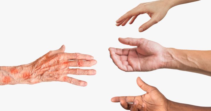 Hari Kusta Internasional: Mengenal Kusta dan Mengakhiri Diskriminasi